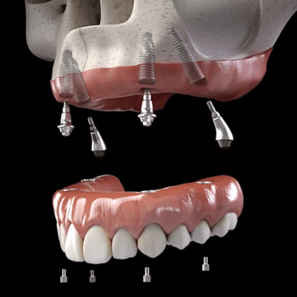 Full-arch implant-supported restoration shown above dental implant posts and abutments