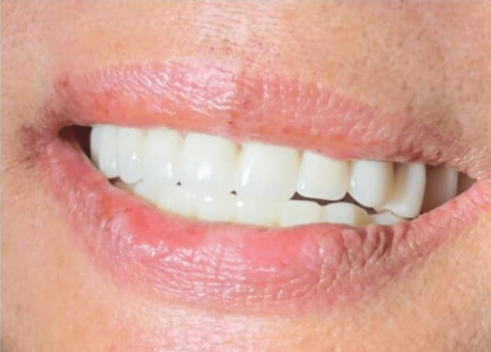 Patient after SMILE In A Day dental implant procedure