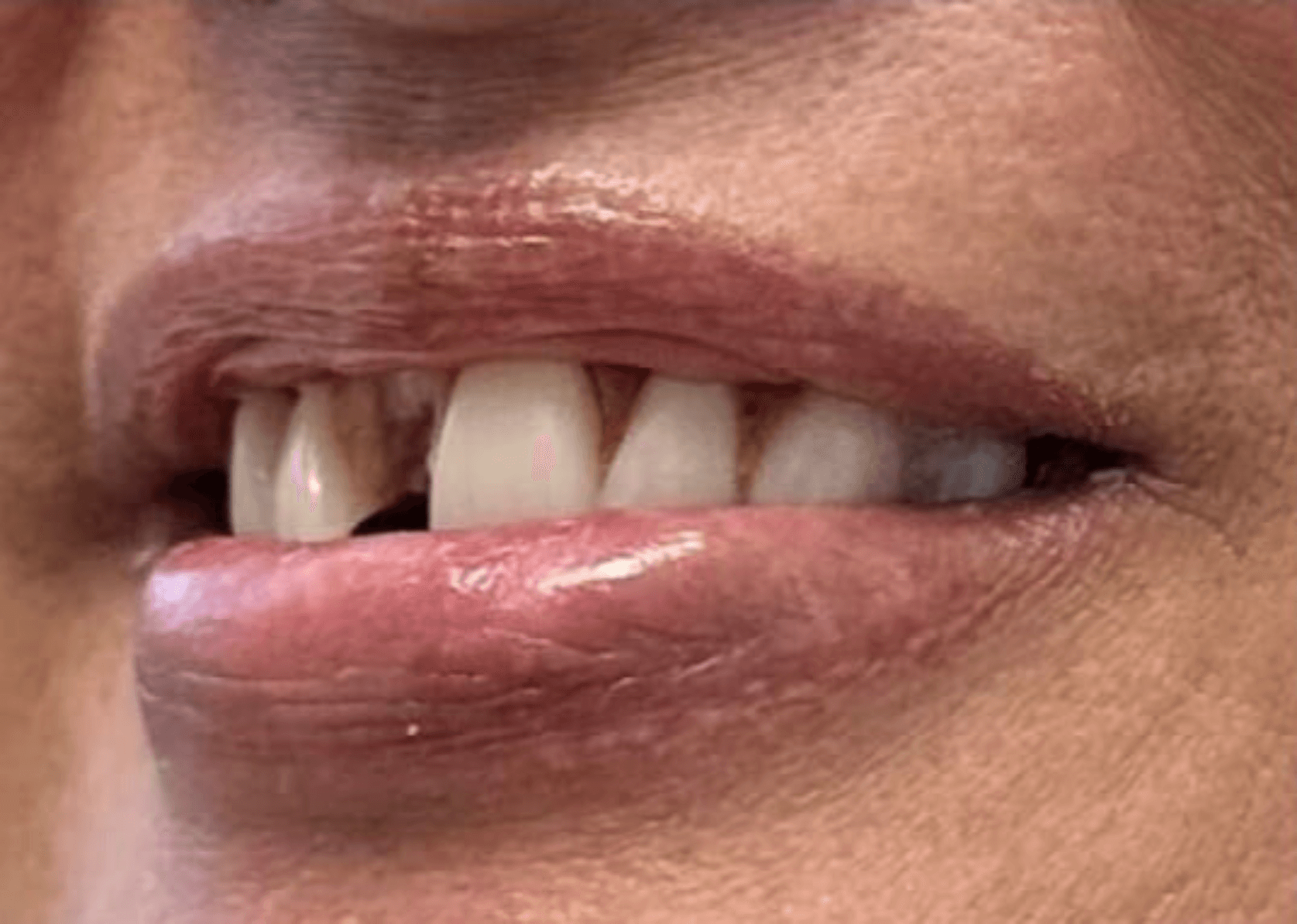 Patient before SMILE In A Day dental implant procedure