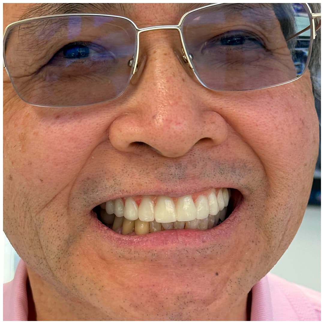 Patient after All-on-X implant complete transformation