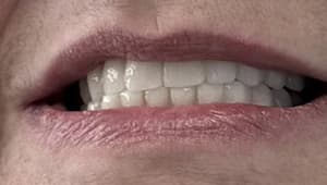 Patient after implants with temporary prosthesis