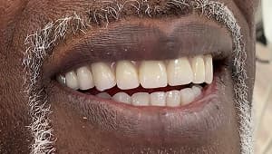 Patient after full mouth restoration with 6 implants