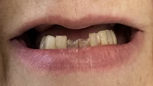 Patient before implants with missing teeth
