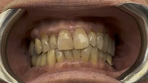 Patient before All-on-X implant procedure