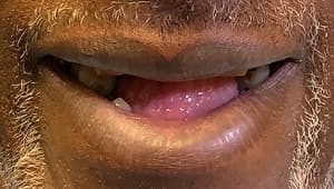 Patient before full mouth restoration
